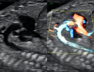 Fatal-Echocardiography-kishangarh-ajmer1