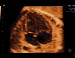 Fatal-Echocardiography-kishangarh-ajmer3