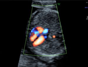 Fatal-Echocardiography-kishangarh-ajmer4